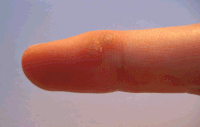 Two viral warts on a middle finger, being treated with a mixture of acids (like salicylic acid) to remove them. A white precipitate forms on the area where the product was applied.