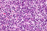 Thumbnail for Hepatoblastoma