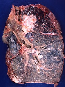 A squamous-cell lung carcinoma developing in the bronchius