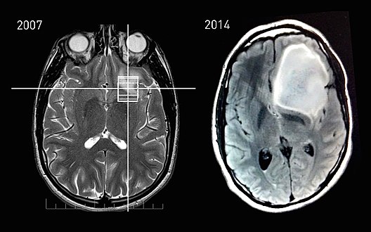 MRI scans of an astrocytoma patient, showing tumor progression over the course of seven years