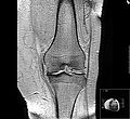 MRI of osteoarthritis in the knee, with characteristic narrowing of the joint space