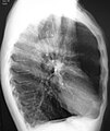A lateral chest X-ray of a person with emphysema, displaying barrel chest and flat diaphragm