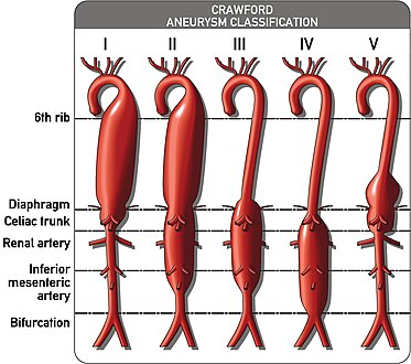 The Crawford Classification (Extent I-IV) and the Safi modification (Extent V) for thoracoabdominal aortic aneurysms is pictured above.