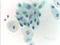 Atrophic squamous cells in postmenopausal women