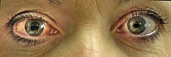 إصابة العين اليمنى بزرق انسداد الزاوية الحاد. لاحظ حجم البؤبؤ واحمرار بياض العين