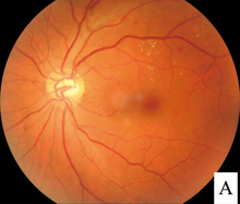 Photograph of retina after scatter laser surgery for diabetic retinopathy.