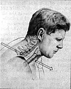 A sketch shows an arrow illustrating the first bullet that struck John F. Kennedy. The bullet is seen entering into his neck and exiting the throat.