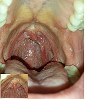 Throat warts before and after carbon dioxide laser treatment.