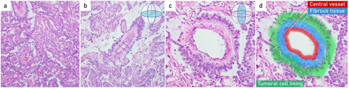 Histopathology of endodermal sinus tumor with Schiller–Duval bodies. (a) papillary pattern combined with small tubopapillary endodermal sinus structure (Schiller–Duval body) in blue circle; (b) marked tubulopapillary sinusoidal structure with central vascular core in longitudinal section (Schiller–Duval body); (c,d) 400× g magnified image plus zoom of diagnostic round cystic Schiller–Duval body in a transverse section, with microcystic and papillary patterns around. The body has a central vessel surrounded by fibrous tissue, called the fibrovascular core, and it is surrounded by layers of the tumoral cells at the surface of that stalk. The structure is located in open cystic space also lined by tumoral cells. All those structures together are called a Schiller–Duval body and resemble primitive glomerulus. H&E stain.[5]