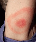 20% of Lyme rashes in the United States show a "bull's eye" or "target-like" appearance.[27][28][29]