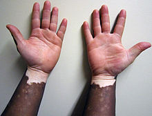 Non-segmental vitiligo on dark skin