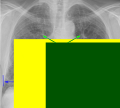 Annotated with signs of heart failure - vector (.svg) version