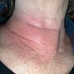 Erythema migrans ("redness migrating") on a woman's neck.[30] Rashes from non-Lyme causes may look similar.[31][32]