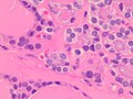 As shown in these microfollicles, it can have mildly enlarged nuclei with mildly clumped chromatin, and clear cytoplasms, but cellular characteristics of papillary thyroid carcinoma are absent.