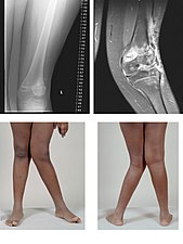 تَشَوُّهٌ أَرْوَح (Valgus deformity). يُلاحظ تزوّي (ميلان) الساق للخارج بعد مفصل الركبة. صورتان ومقطعان بالرنين المغناطيسي MRI.