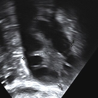 Polycystic ovary as seen on sonography