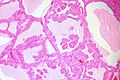 The follicular linings may be thickened, with papillary projections (but lack nuclear features of papillary thyroid carcinoma)