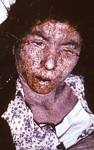 이 이탈리아인 여성 천연두 환자의 피부에서 천연두 말기 특유의 반구진 흉터를 알아볼 수 있다. 1965년 촬영.