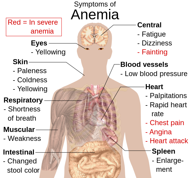 File:Symptoms of anemia.svg