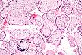 Micrograph of CMV placentitis