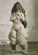 A striking example of objectification.[17] Published as Bellevue Venus by Oscar G. Mason, for depicting elephantiasis.