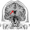 Coronal T2 (grey scale inverted) MRI of the brain at the level of the caudate nuclei emphasizing corpus callosum