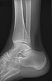 Lateral oblique (to visualize the posterior border of the tibia)