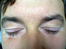 Non-segmental vitiligo of the eyelids