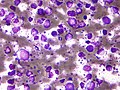 Thumbnail for B-cell lymphoma