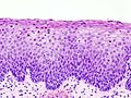 CIN II（II級）不典型增生細胞占宮頸上皮層的下部2/3，病變部分與正常細胞層分界清楚。