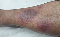 Several lesions of erythema nodosum in an individual with dark skin