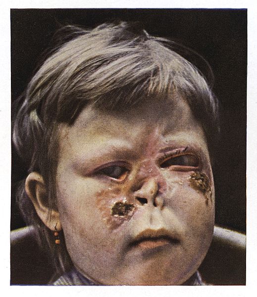 File:A girl suffering from secondary Syphilis to the face Wellcome L0038266.jpg