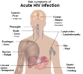 A diagram of a human torso labeled with the most common symptoms of an acute HIV infection