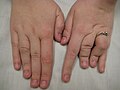 Thumbnail for Larsen syndrome