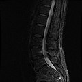 MRI lumbar spine with degeneration (sagittal FAST STIR)