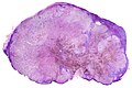 Gangli limfàtic amb reemplaçament gairebé complet del seu teixit per la metàstasi d'un melanoma. El pigment marró és la deposició focal de la melanina.