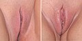 Uyarılmamış bir vulva (sol), cinsel olarak uyarılmış bir vulva (sağ).