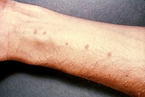 Пухирі на шкірі передпліччя, спричинені паразитом роду Schistosoma