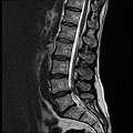 MRI lumbar spine with degeneration (sagittal T2 FRFSE)