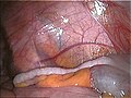 Vermiform appendix