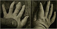 Swollen hands and fingers of an infant