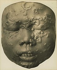 Secondary breakout in a 12-year-old Javanese child (wax model)