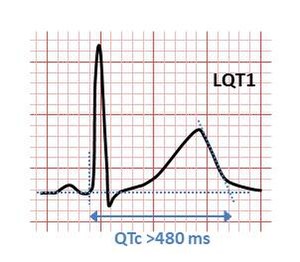 ЕКГ при спадковому синдромі подовженого QT(LQT1).Інтервал QT >480ms вважається аномально подовженим.
