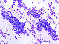 Fibroadenoma, fine needle aspiration biopsy (Giemsa or DiffQuick stain). The image shows abundant bare bipolar stromal nuclei surrounding sheets of metachromatic epithelial cells.