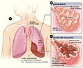 Thumbnail for Lobar pneumonia