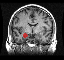ภาพอะมิกดะลาผ่าหน้าหลัง (coronal) โดย MRI