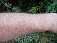 Male forearm showing healed skin with a creamy, shiny patch having pigmentation loss