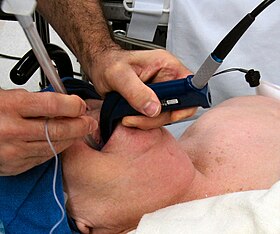 Photograph of an anesthesiologist using the Glidescope video laryngoscope to intubate the trachea of an elderly person with challenging airway anatomy