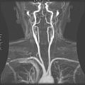 Magnetic Resonance Angiography; view from the front