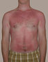 Слънчевото изгаряне е типичен пример за изгаряне от първа степен.